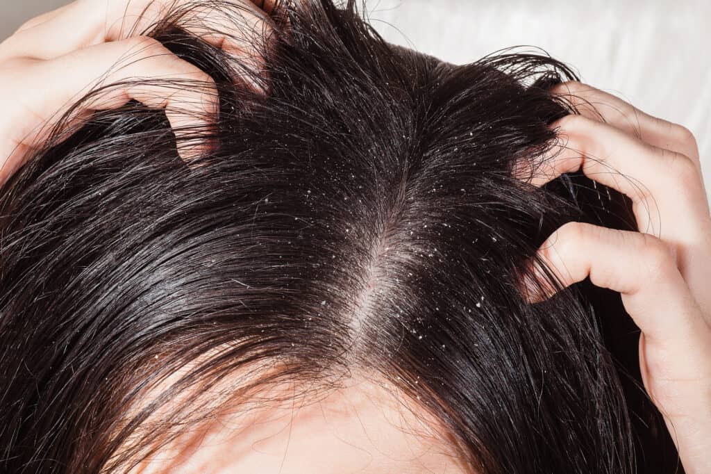 close up of flakes on a scalp - tgel vs tsal